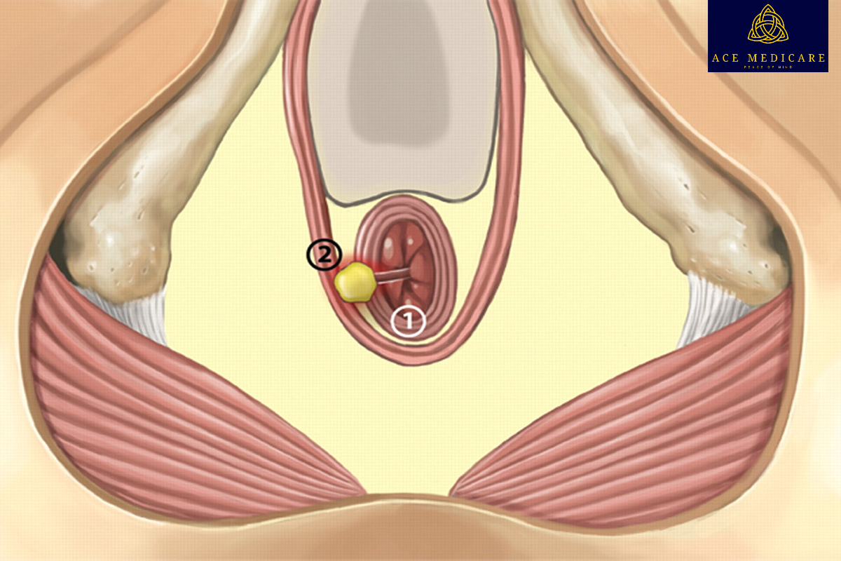 Complications of Anal Fistula: Risks and Prevention Strategies